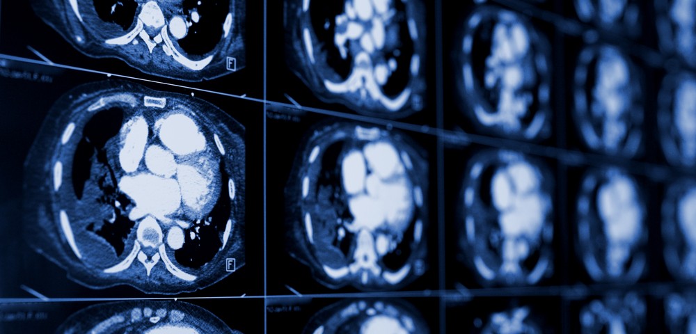 Certain Interstitial Pneumonitis Patients May Be Diagnosed, Managed with Computed Tomography