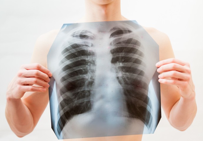 Mycoplasma Pneumonia May Be Diagnosed Better with Integrated Physical, Radiological Findings